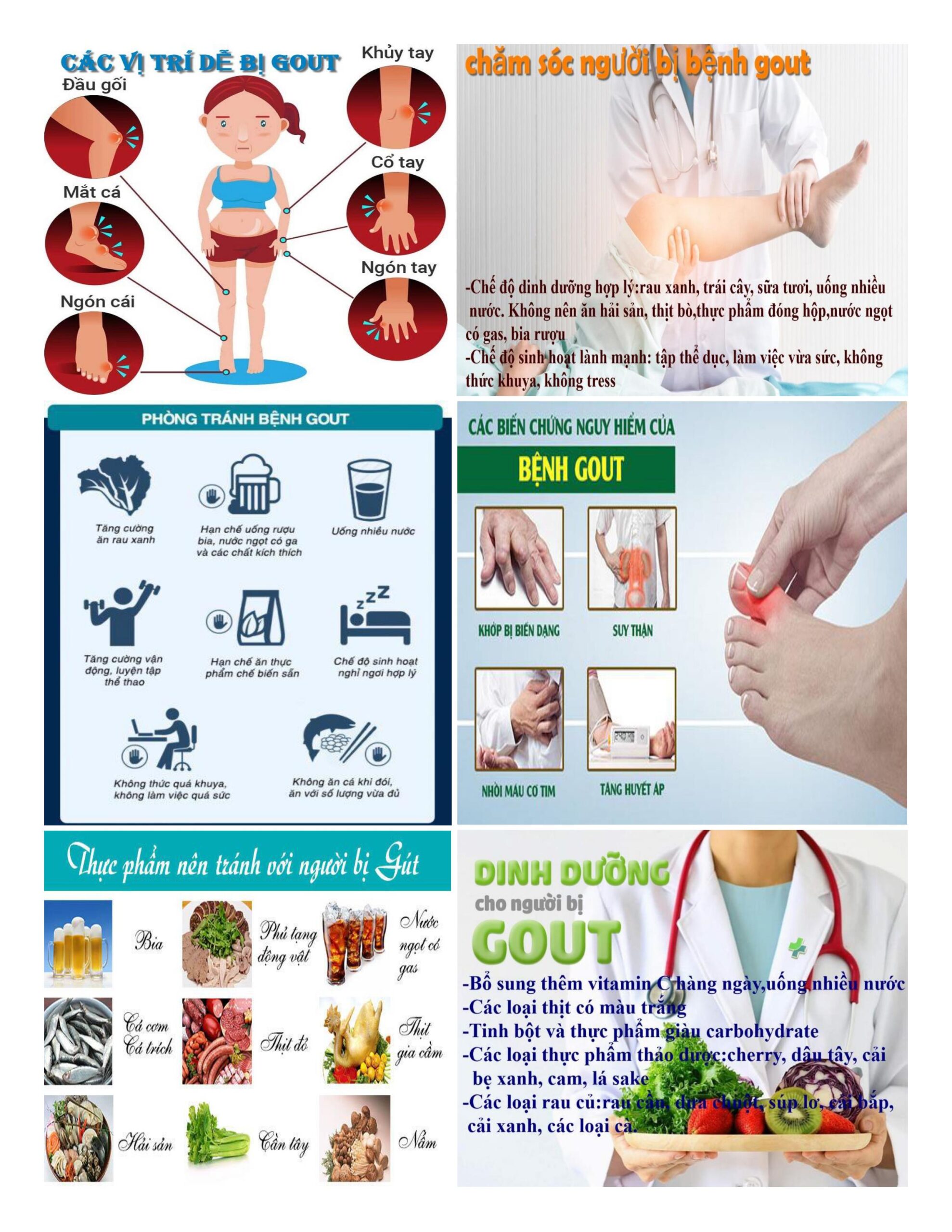 Hình ảnh minh họa bệnh gout gây sưng đau khớp ngón chân và viêm khớp do tinh thể urat tích tụ
